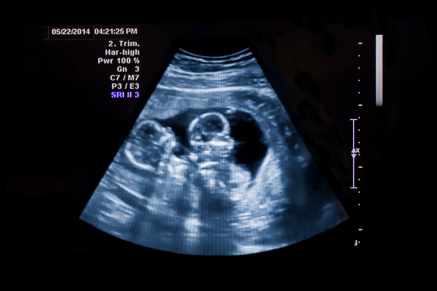 dreaming of being pregnant with twins